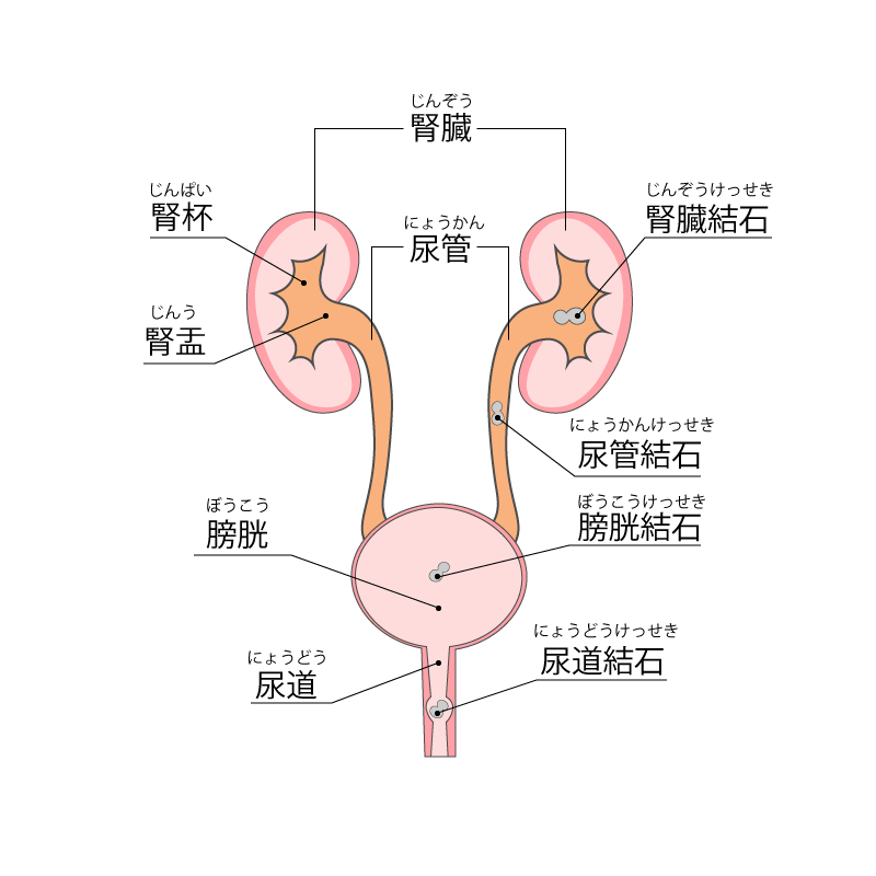 暑い季節は要注意 尿路結石のお話 岡村一心堂病院