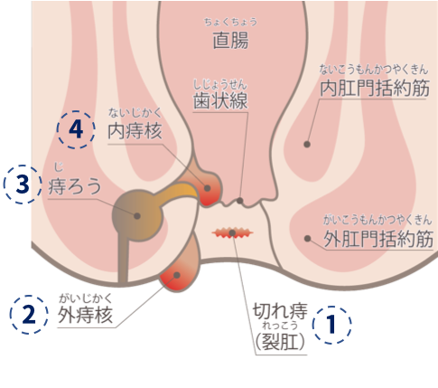 The おしりのトラブル 岡村一心堂病院